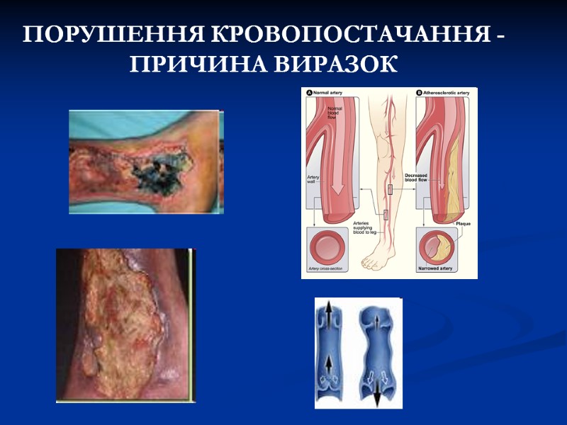 ПОРУШЕННЯ КРОВОПОСТАЧАННЯ - ПРИЧИНА ВИРАЗОК ПОРУШЕННЯ КРОВОПОСТАЧАННЯ - ПРИЧИНА ВИРАЗОК